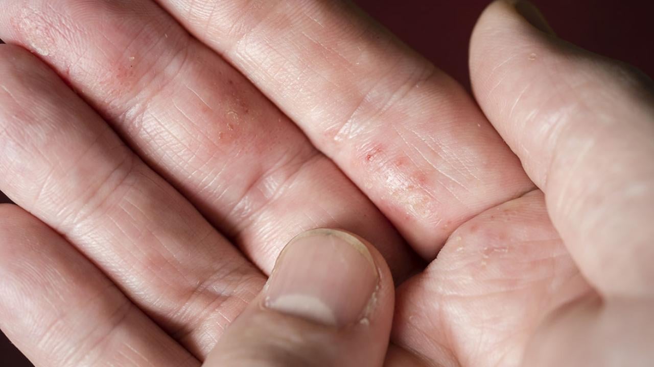 Understanding Bumps on Fingers and Hands