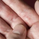 Understanding_bumps_on_fingers_and_hands