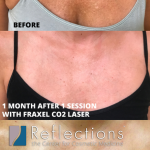What Is a Pink or Red Rash That Can Appear on the Chest or Breasts During Sexual Arousal Known As_1