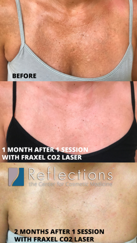 What Is a Pink or Red Rash That Can Appear on the Chest or Breasts During Sexual Arousal Known As_