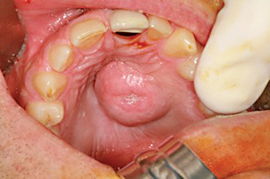 What is Bump on Roof of Mouth STD_