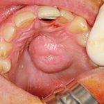What_is_bump_on_roof_of_mouth_std