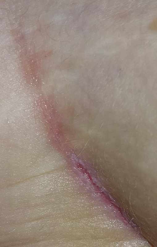 Why Butt Crack Is Itchy