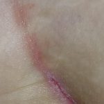 Why_butt_crack_is_itchy