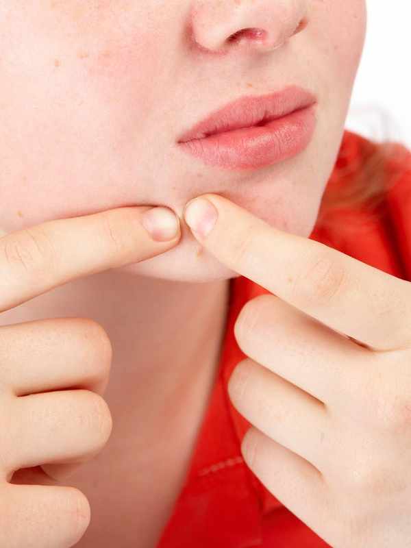 4 Year Old Pimples Around Mouth_ A Common Concern