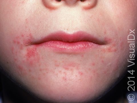 4 Year Old Pimples Around Mouth
