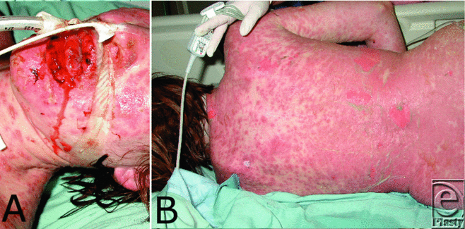 bactrim Toxic Epidermal Necrolysis