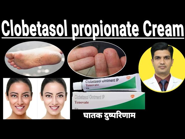 clobetasol Propionate Cream Used For
