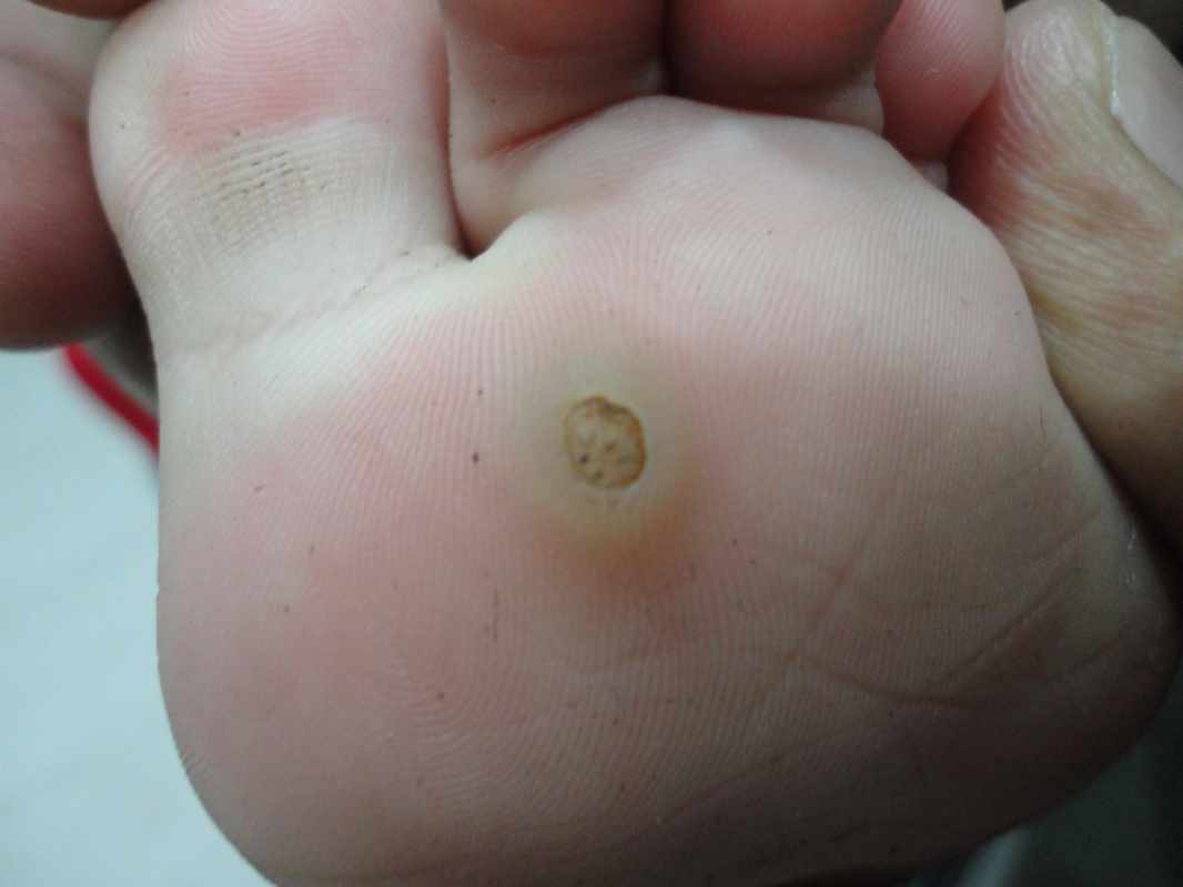 clogged sweat glands in feet_ Pictures of Fungal Infections